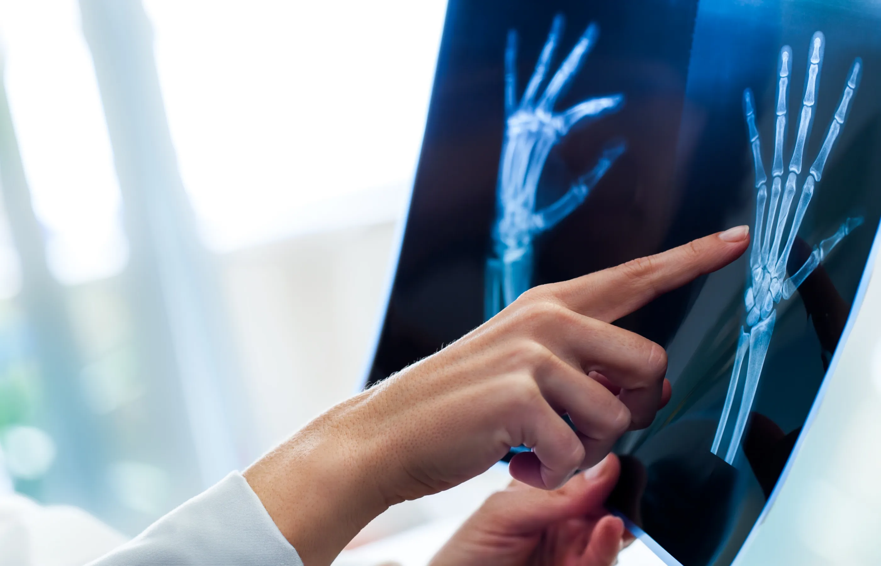 A provider is reviewing an x-ray of a patients hand. 