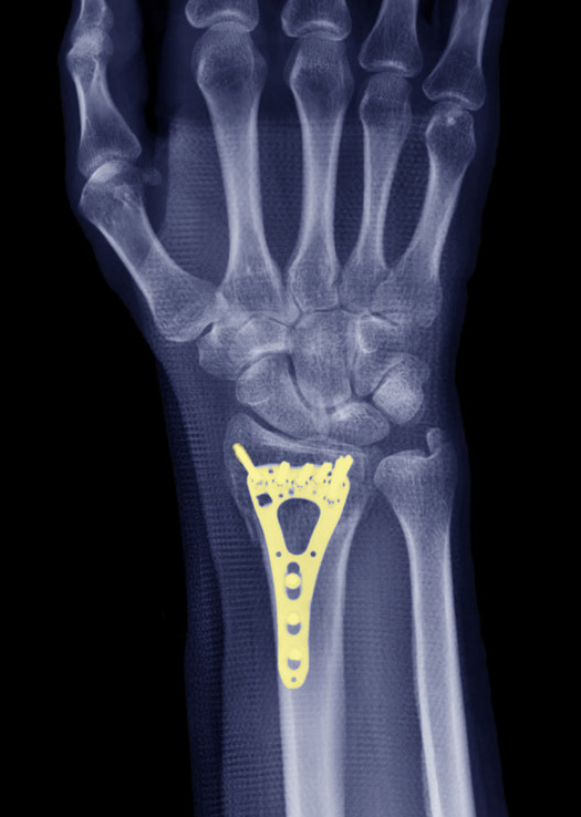 X-ray of a wrist with plating to repair a distal radius fracture