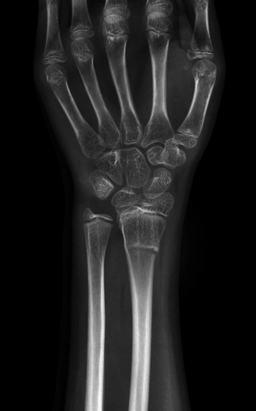 X-ray showing a distal radius fracture