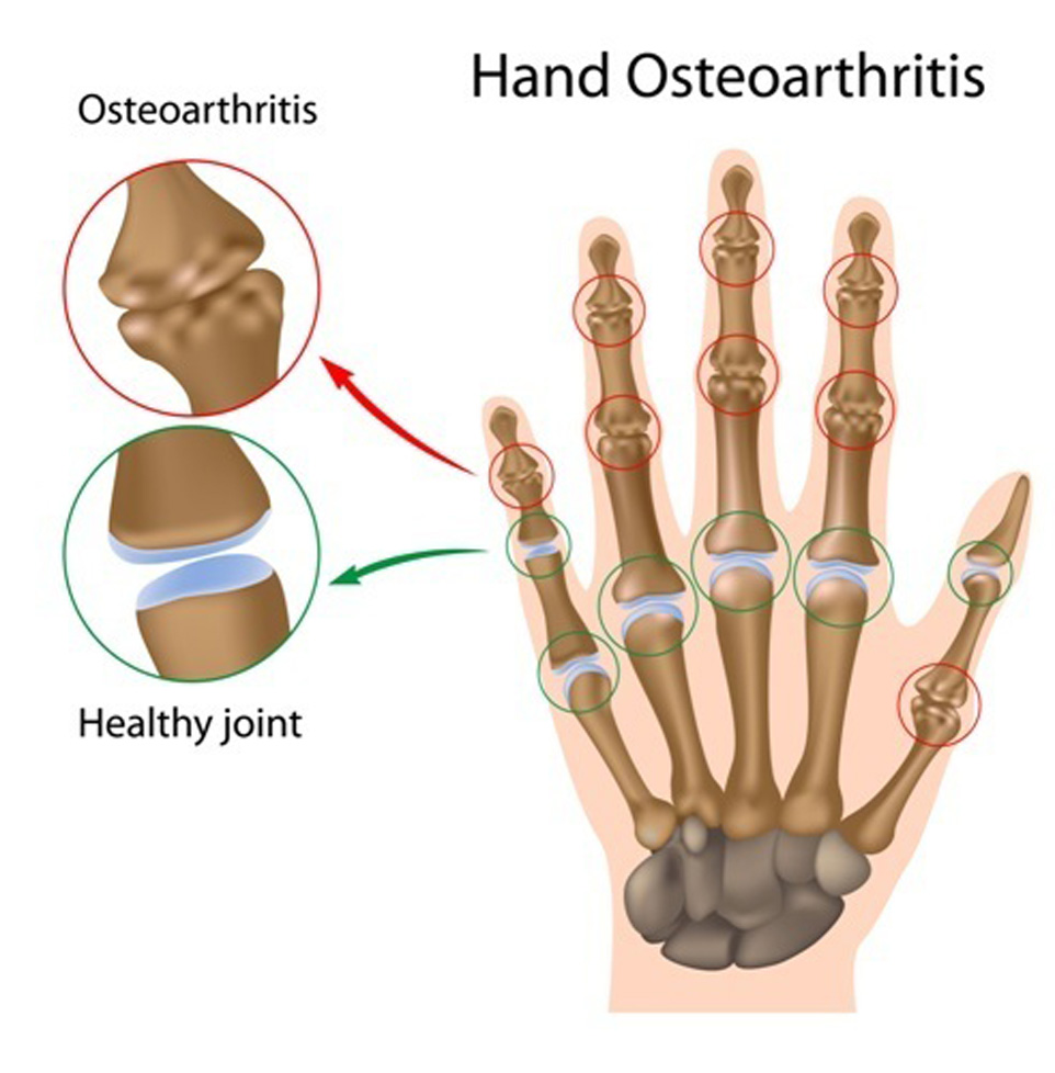 Illustration of Osteoarthritis in the hand causing pain and stiffness.