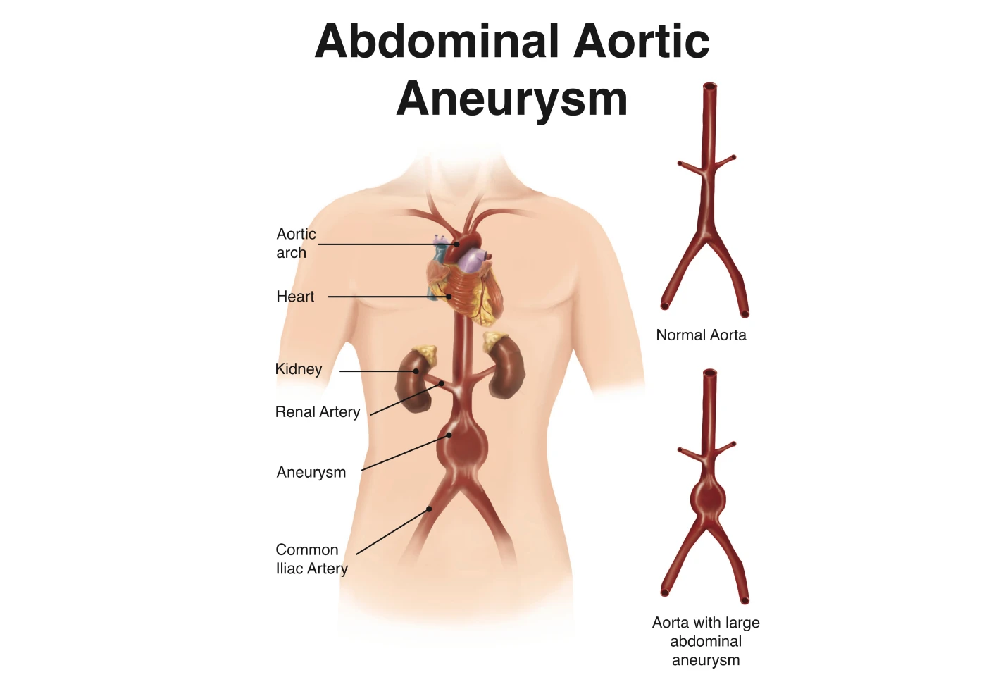 Medical diagram showing an abdominal aortic aneurysm and comparison with a normal aorta. 