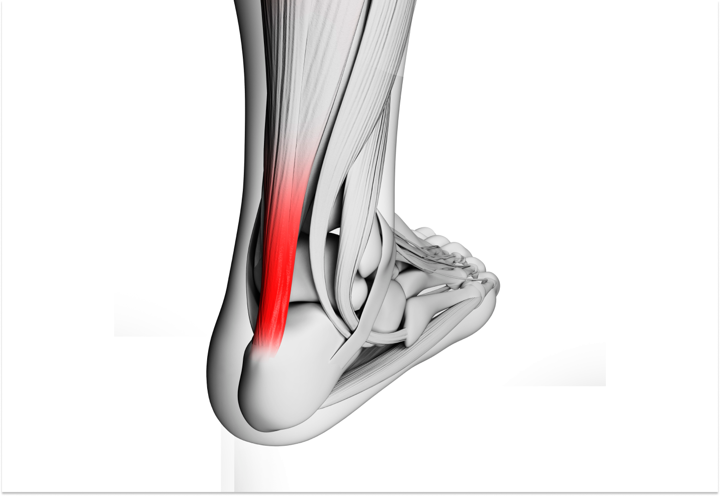 A 3D illustration of the ankle with the Achilles tendon highlighted in red.