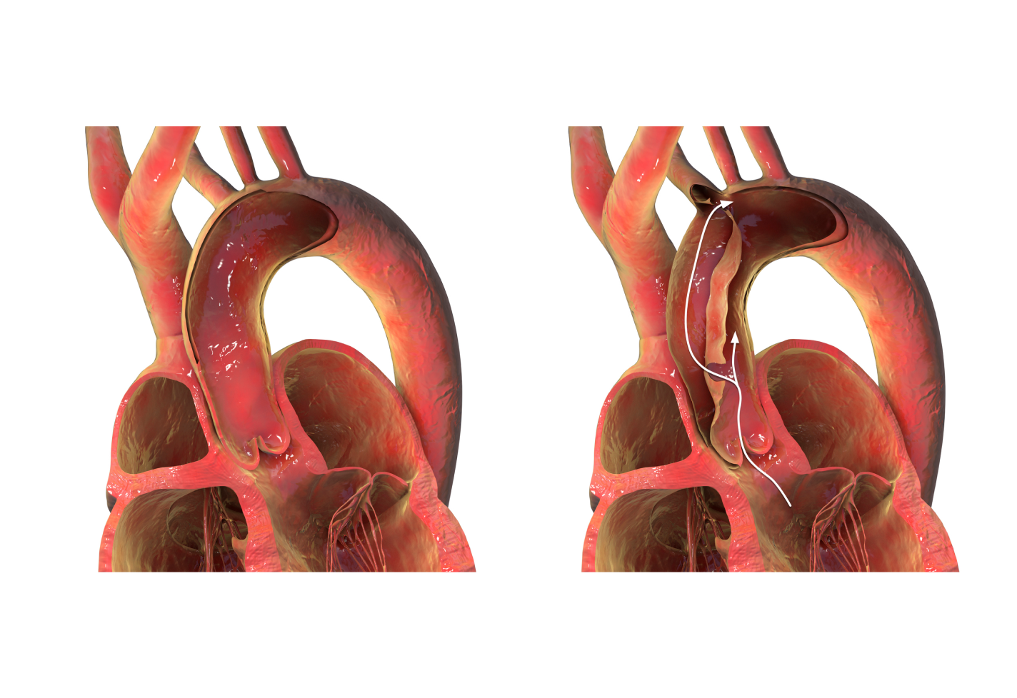 Medical illustration of a normal aorta compared with aortic dissection.