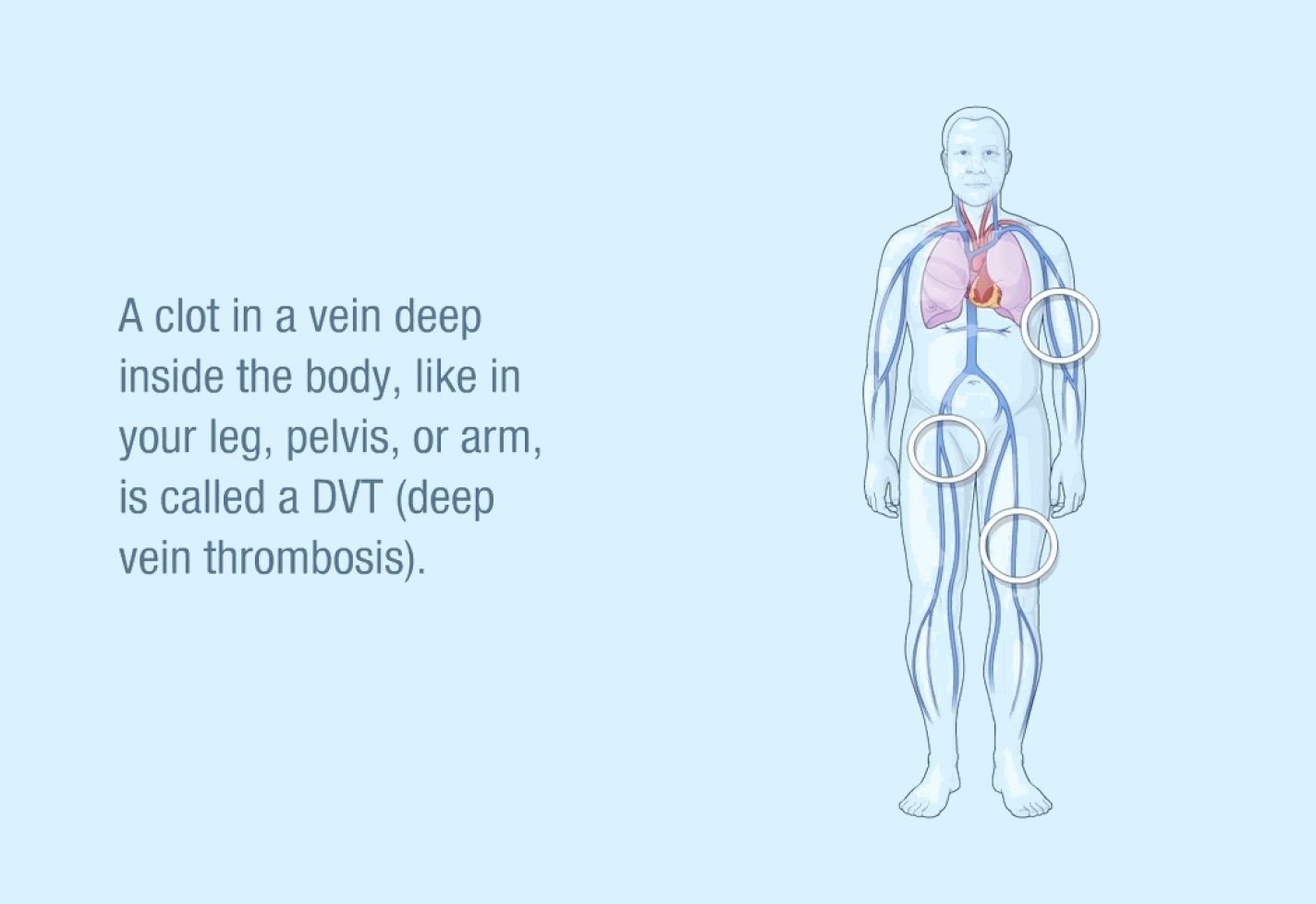 A medical illustration of the circulatory system to show an example of deep vein thrombosis.