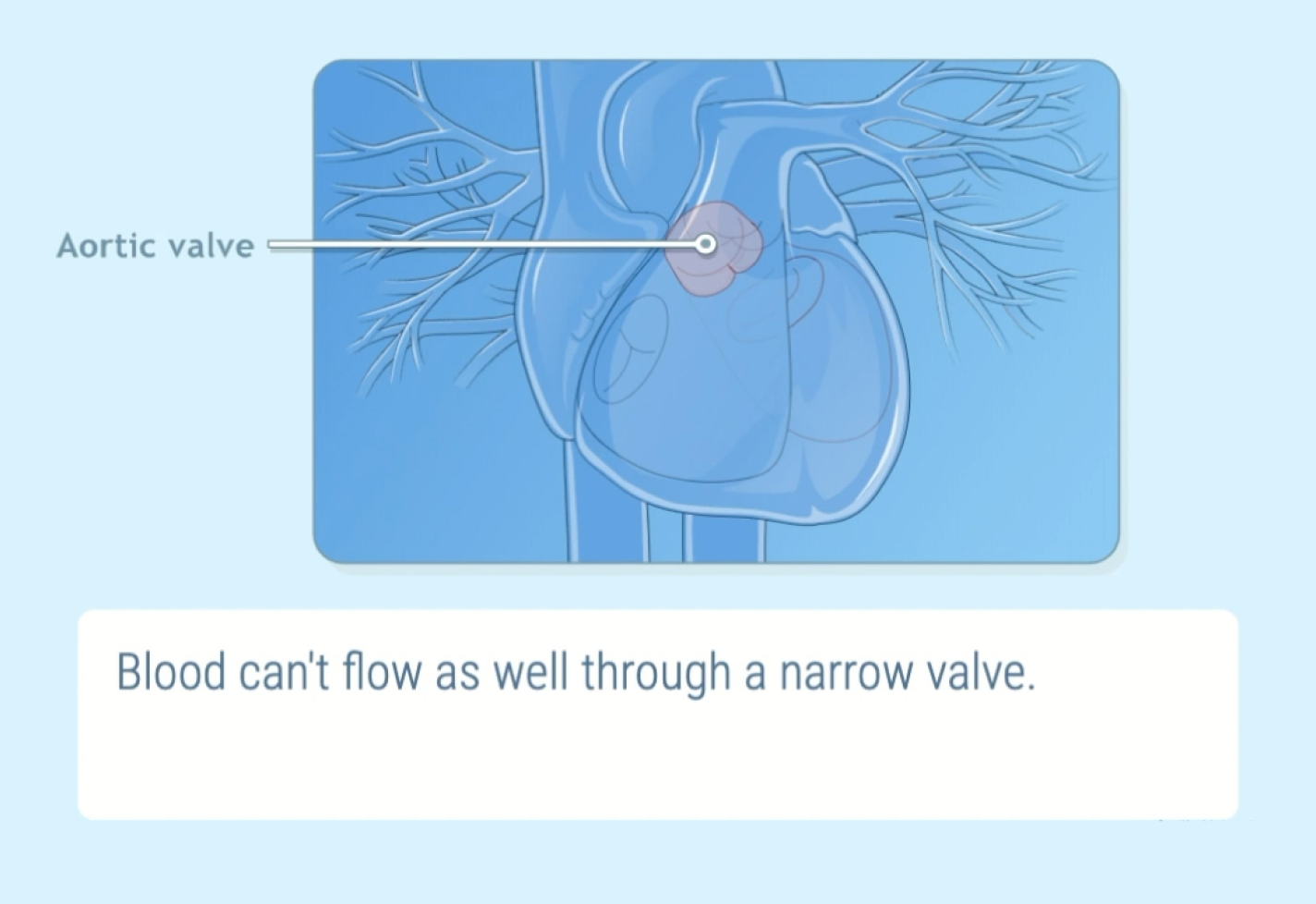 A medical illustration of a heart with focus on the aortic valve.