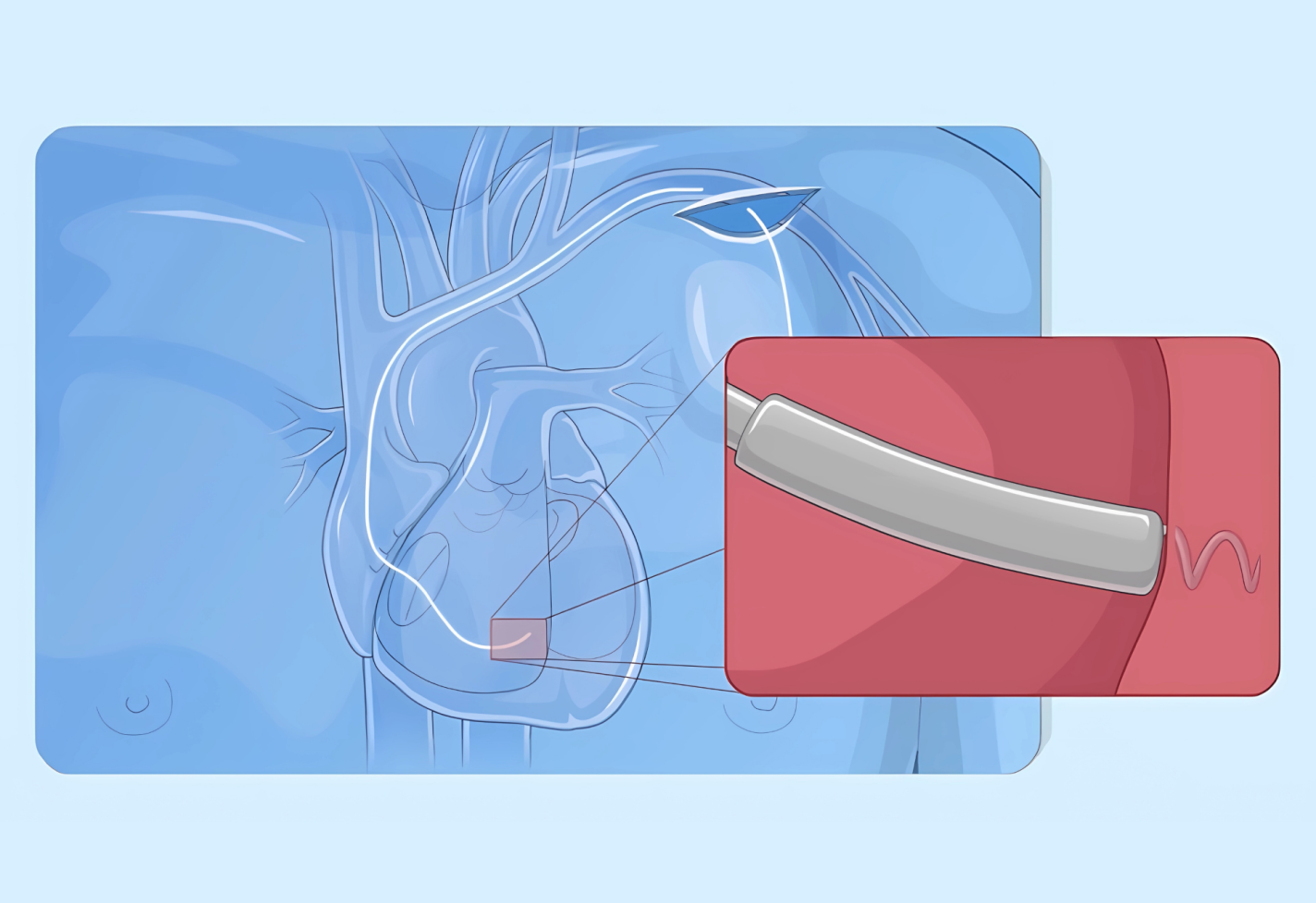 A medical illustration of a heart with an LVAD device installed.