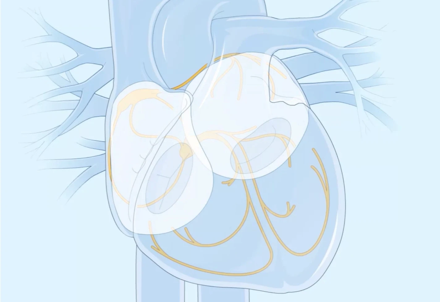 A medical illustration of a heart affected by ventricular tachycardia.