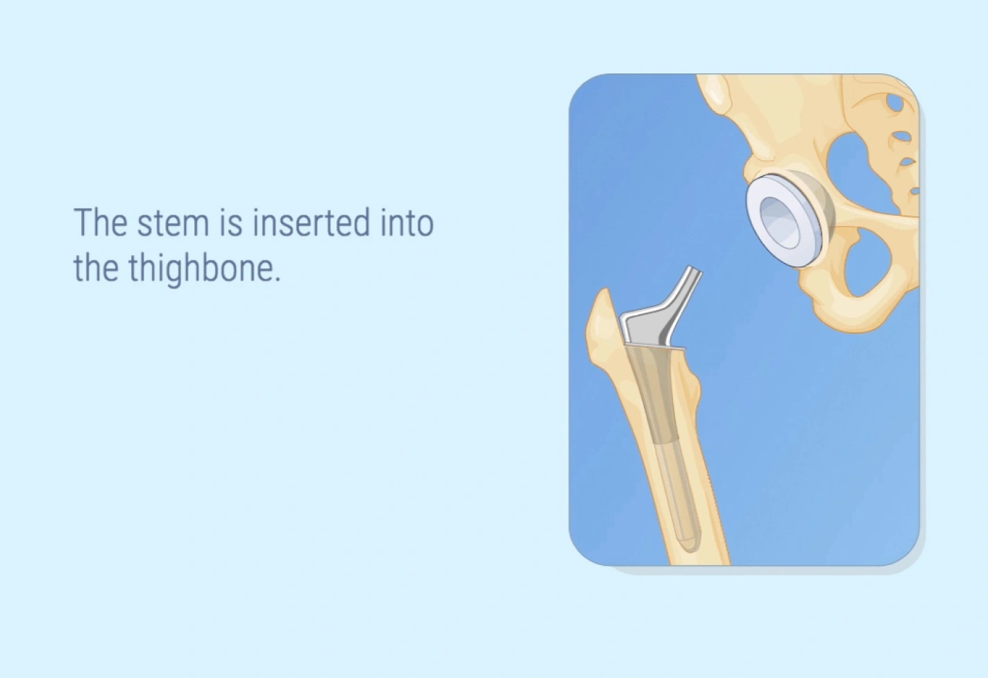A medical illustration of a total hip replacement procedure.