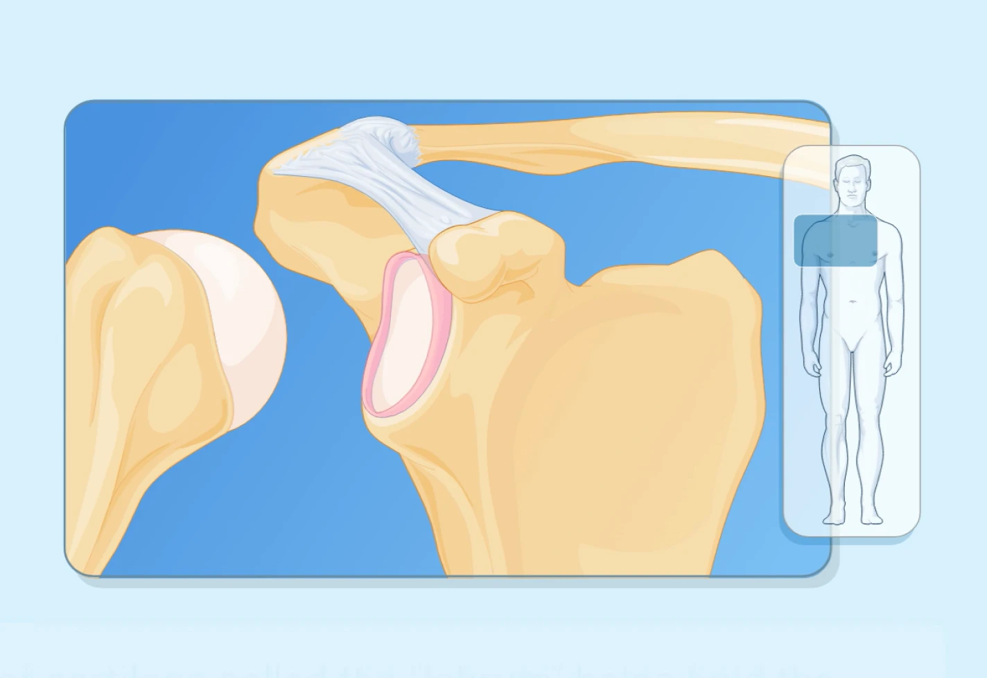 Medical illustration of shoulder joint anatomy used to explain a shoulder arthroscopy procedure. 