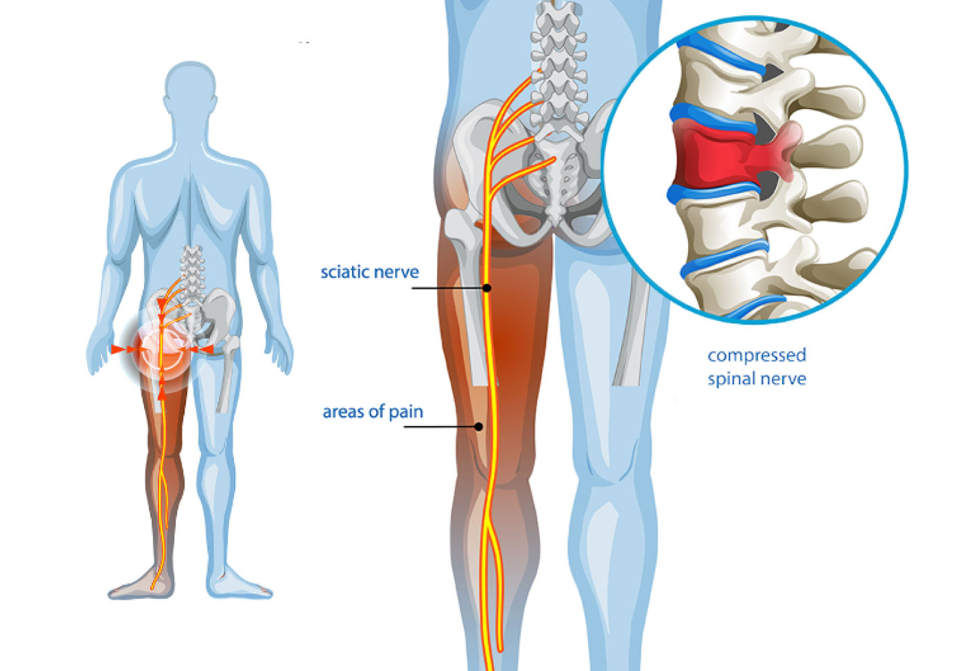 A diagram showing the sciatic nerve, areas of pain in the leg, and a close-up of a compressed spinal nerve.
