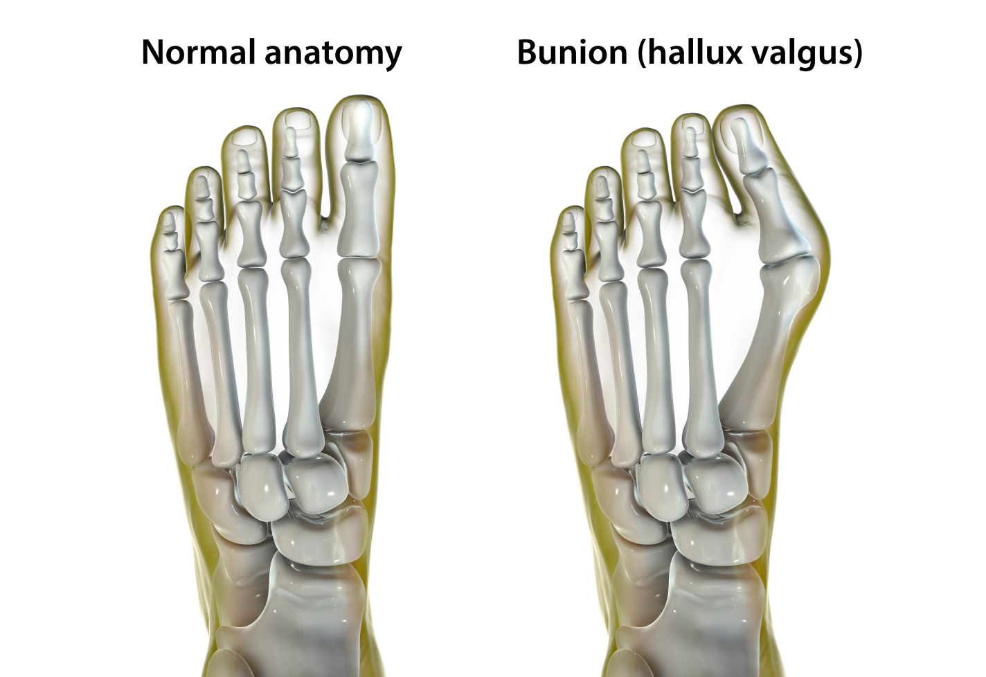 Comparison of normal foot anatomy and a foot with a bunion (hallux valgus).
