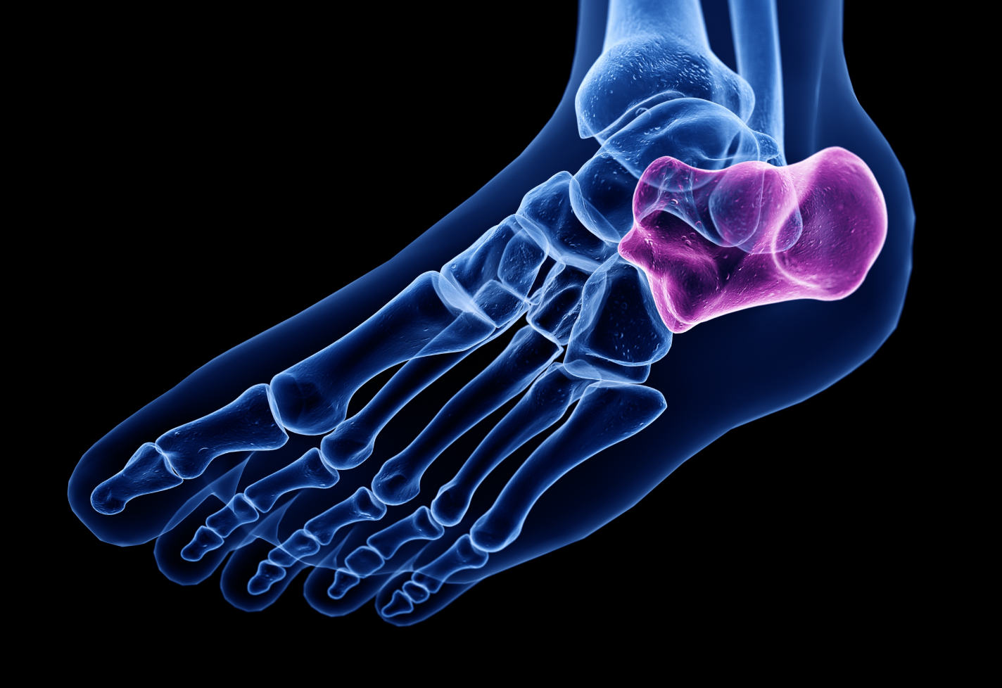 An X-ray image of a foot showing bones, with the calcaneus bone highlighted.
