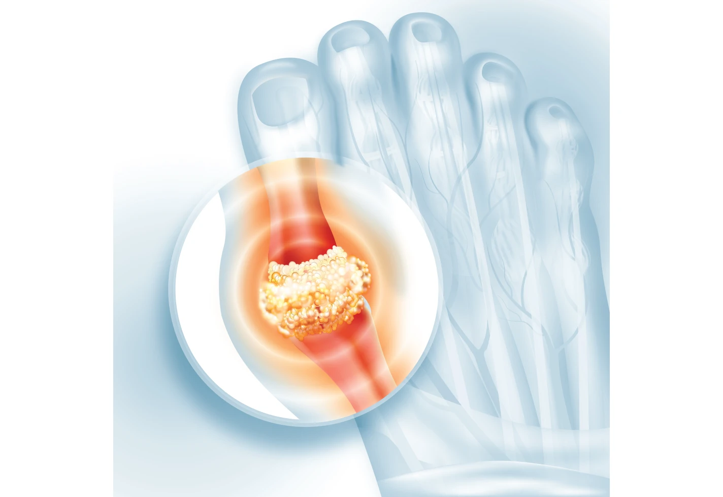 Medical illustration showing gout inflammation and uric acid crystal buildup in the big toe joint. 