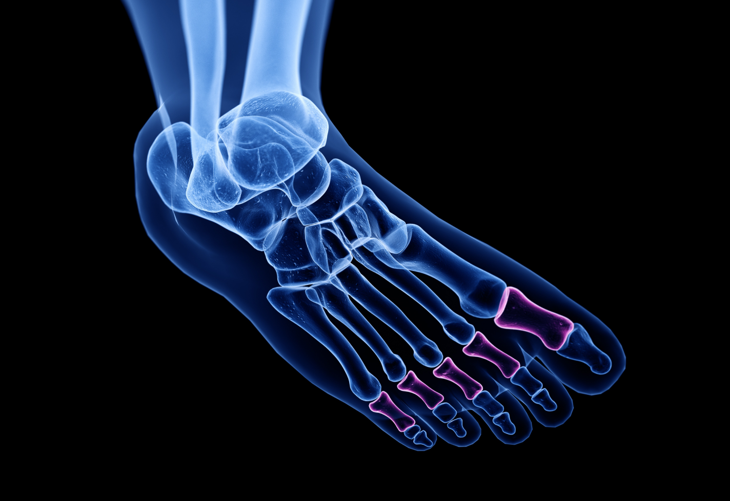 X-ray image of a foot showing bones, with proximal phalanx highlighted.