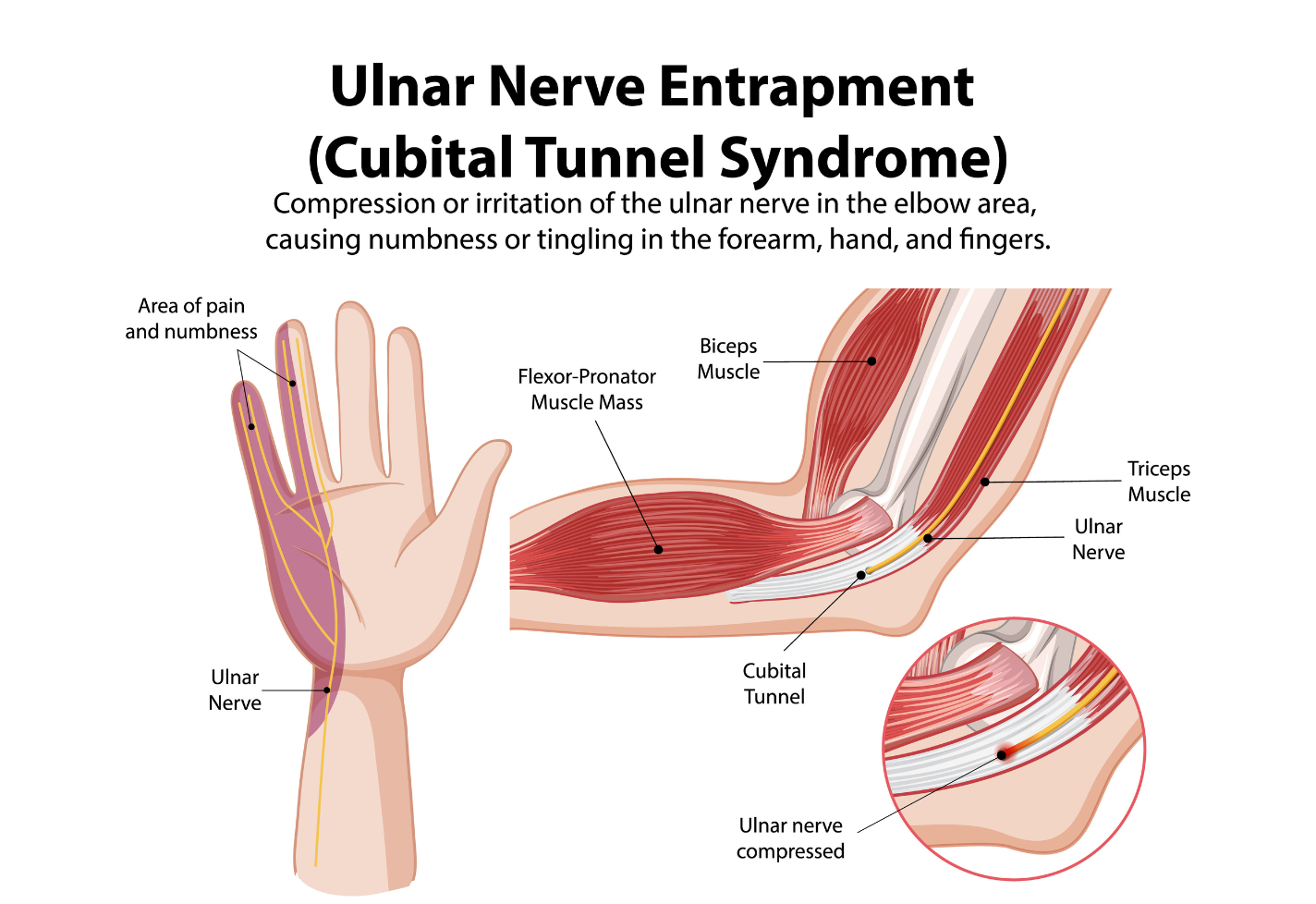 Cubital tunnel syndrome, also known as ulnar nerve entrapment is compression or irritation of the ulnar nerve in the elbow area