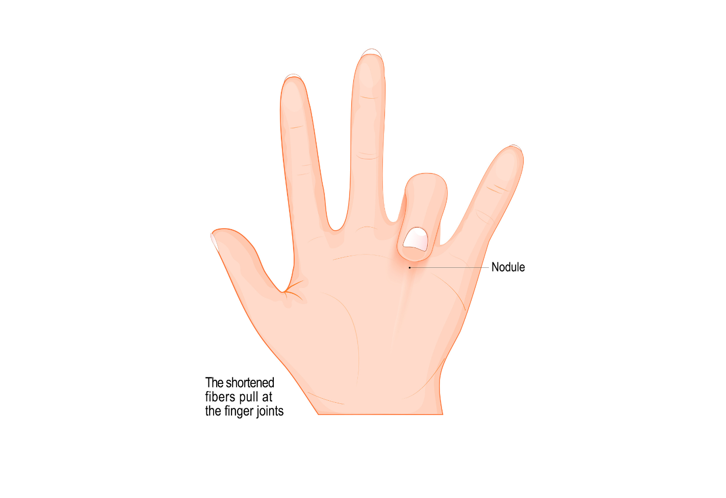 In people with Dupuytren’s contracture, the abnormal tissue gradually stiffens the palm, limiting flexibility and making it harder to fully straighten the affected fingers.