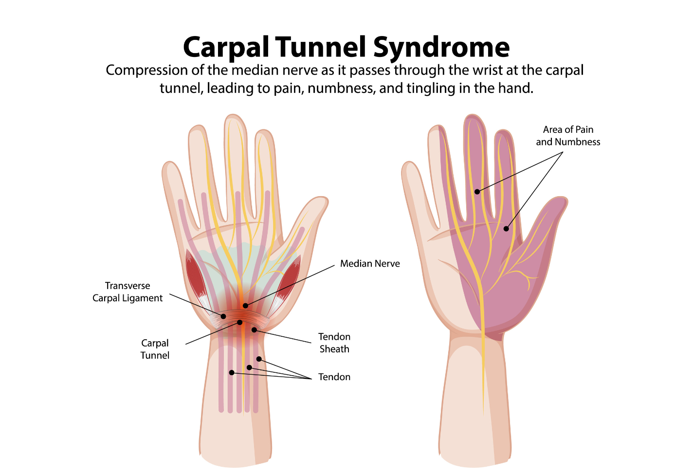 Carpal Tunnel Syndrom is compression of the median nerve as it passes through the wrist at the carpal tunnel.