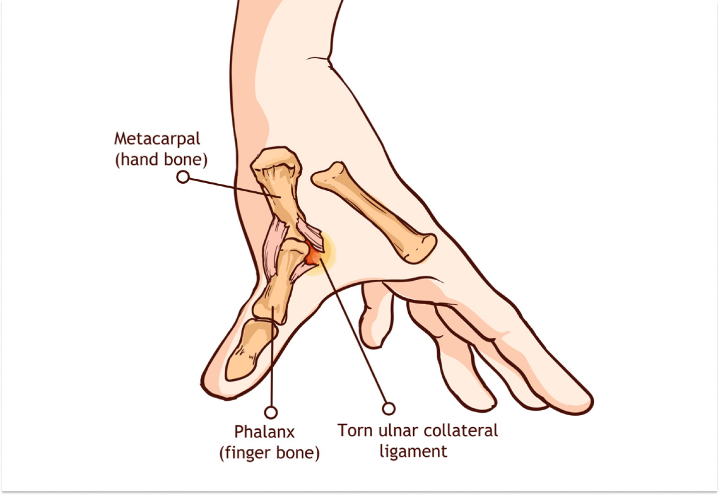 Illustration of a hand showing an ulnar collateral ligament sprain, labeled parts include metacarpal, phalanx, and torn ligament.