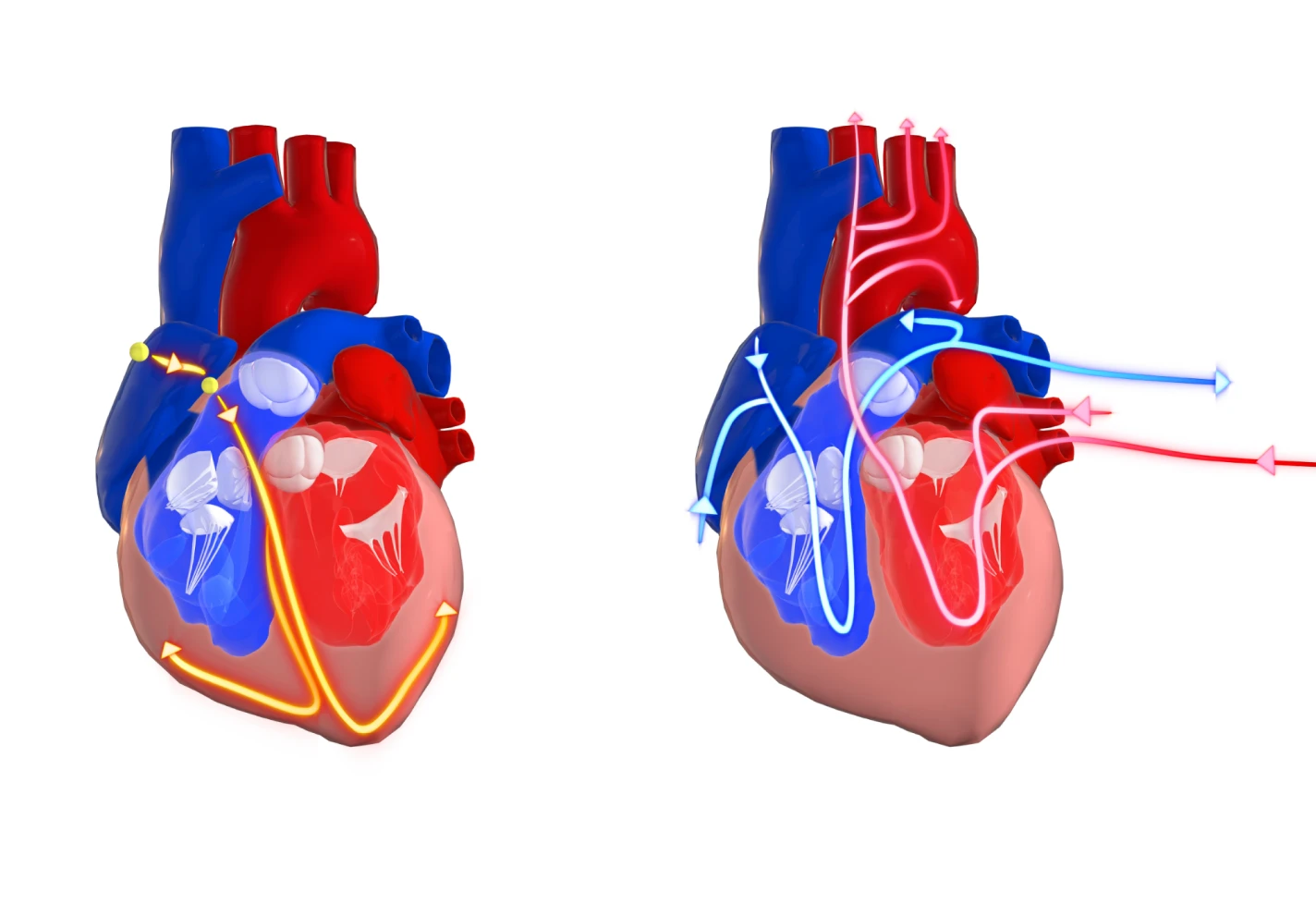 Medical illustration comparing internal heart anatomy and blood flow pathways.    