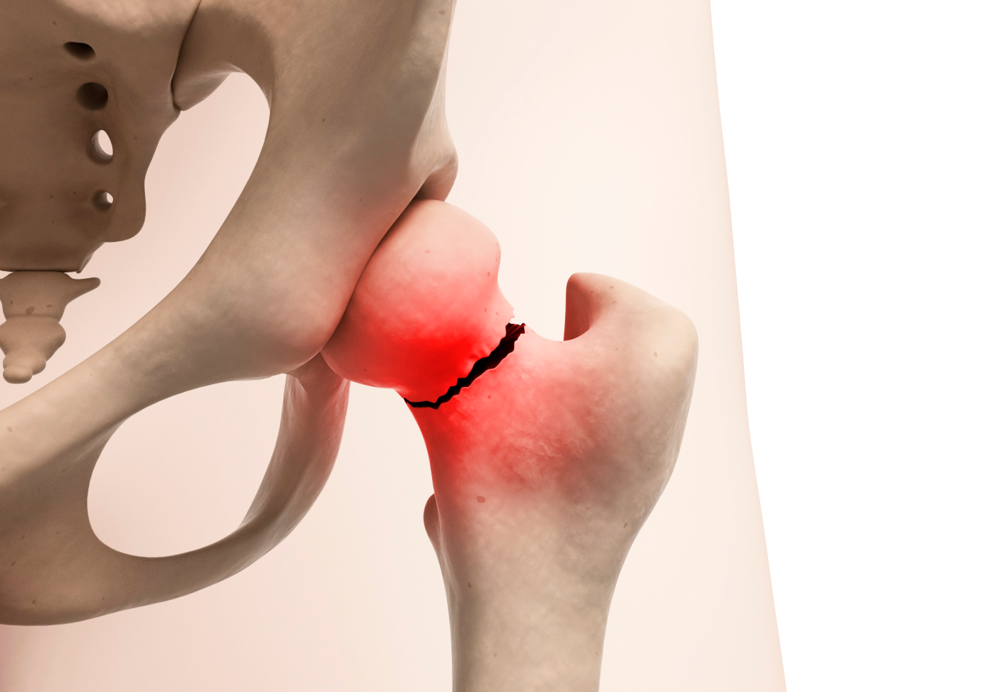 Close-up of a human hip joint with a highlighted fracture, showing damaged bone and red inflammation.