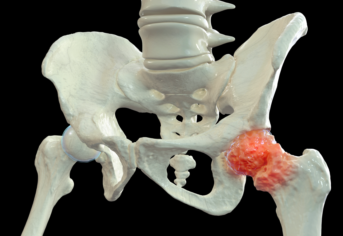 3D model of human pelvis with a highlighted swollen area on the hip joint.