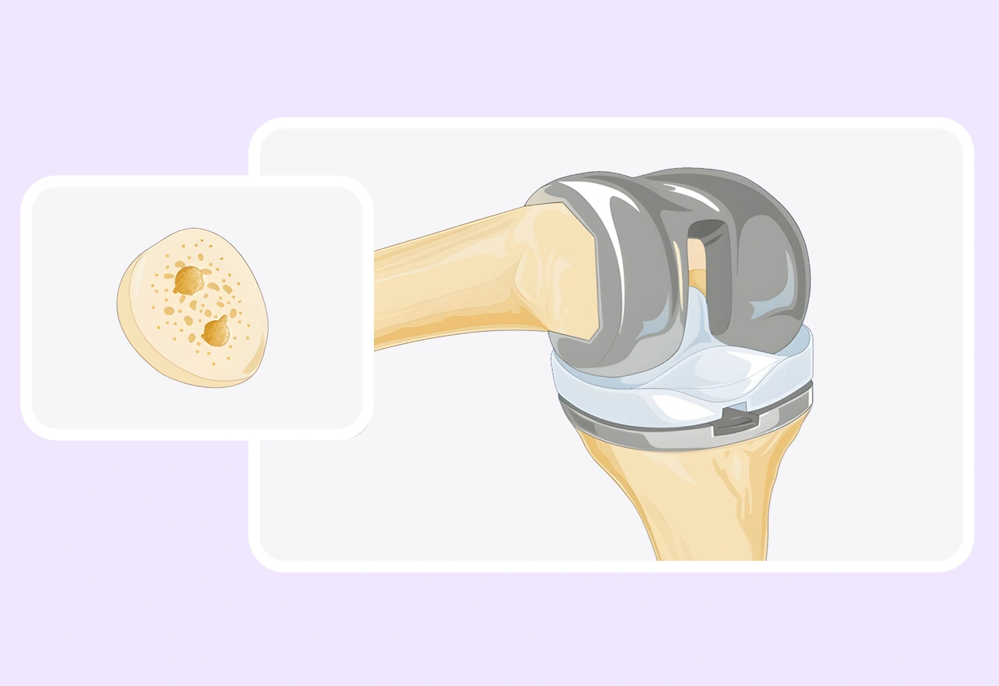 Illustration showing a joint with a prosthetic implant and a close-up of bone structure.