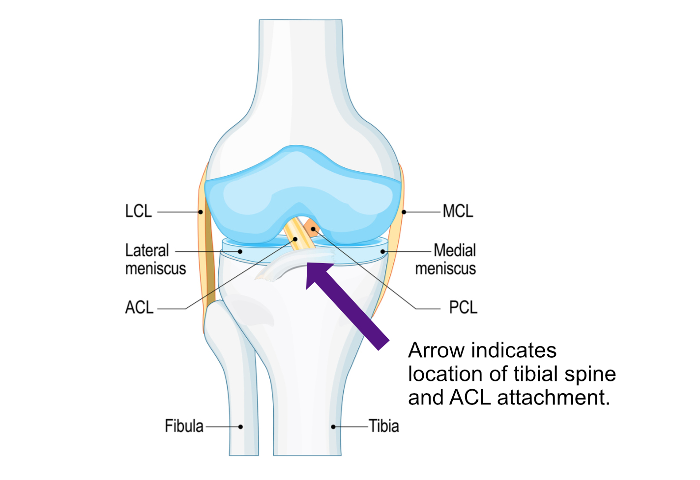 A medical illustration of a knee joint with a description of tibial spine avulsion.
