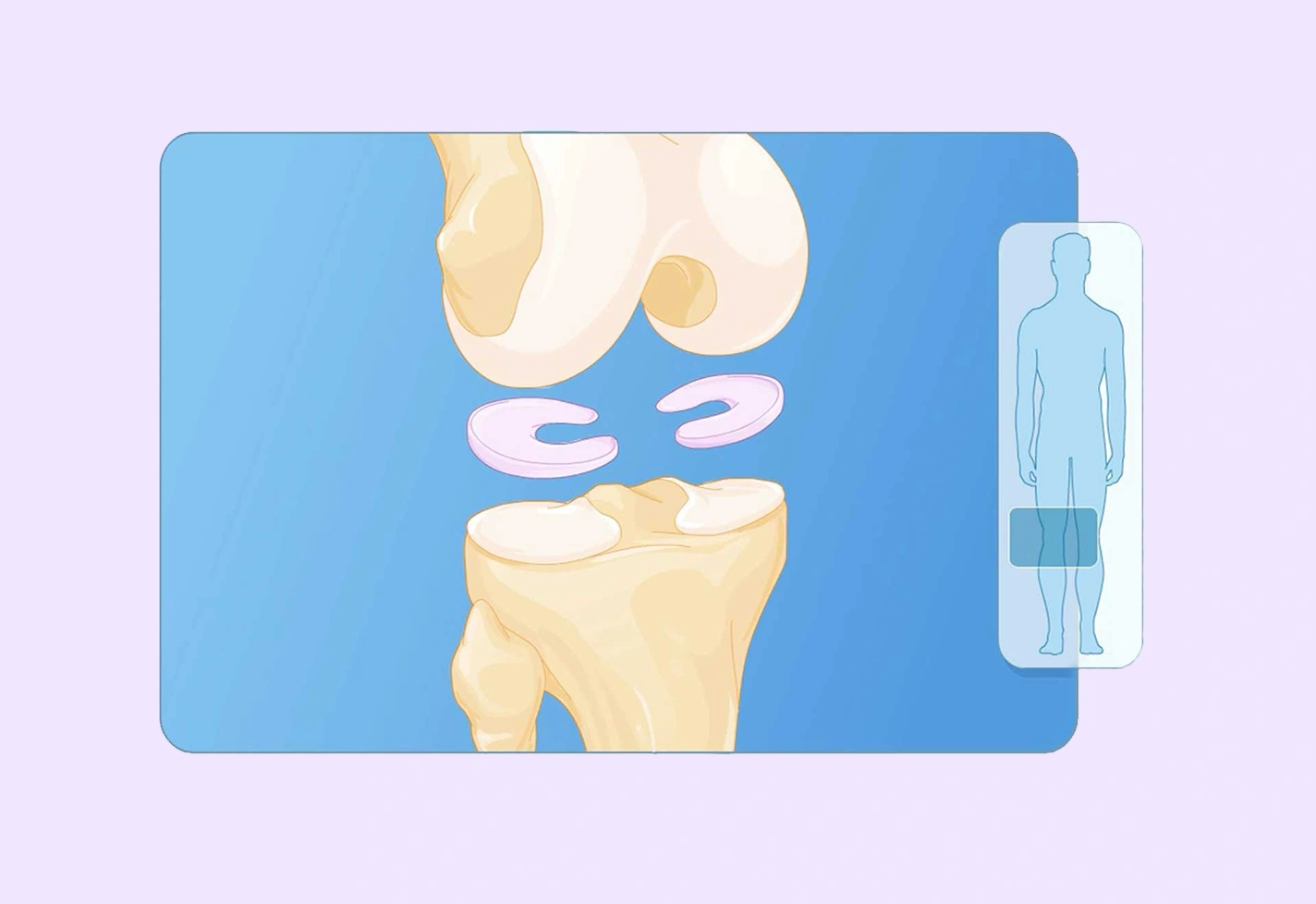 Illustration of knee joint showing femur, meniscus, and tibia.
