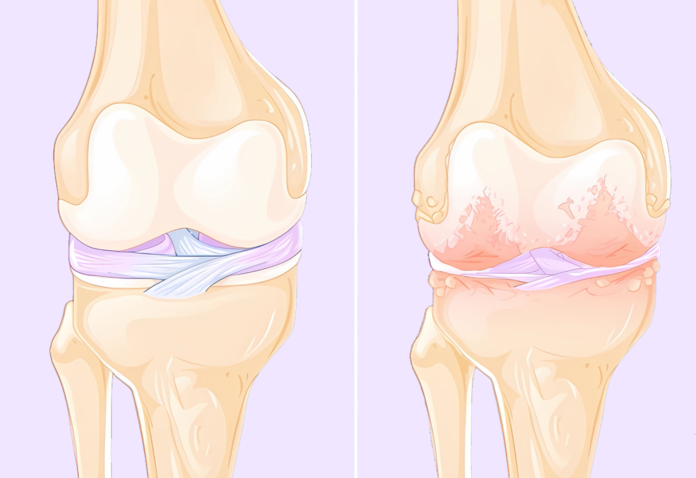 A diagram showing a healthy knee joint on the left and a damaged knee joint on the right, highlighting wear.