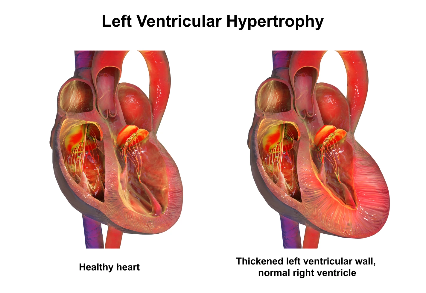 Medical diagram comparing a healthy heart and left ventricular hypertrophy.    