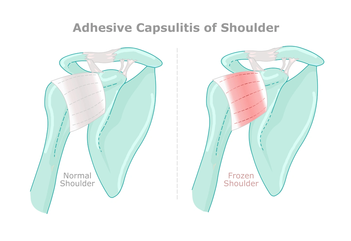 Diagram comparing a normal shoulder and a frozen shoulder, showing adhesions.
