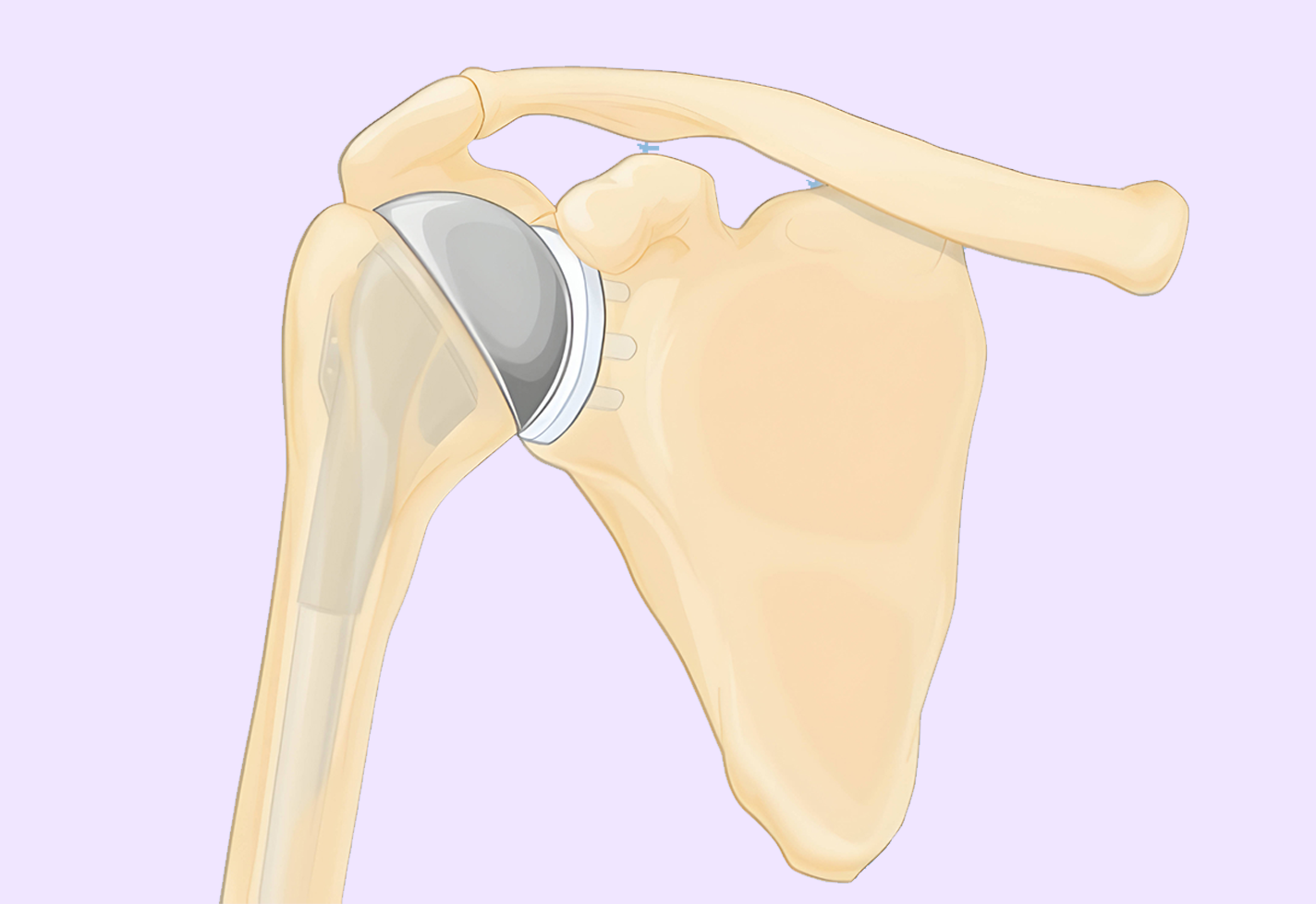Illustration of a shoulder joint with a metal implant.