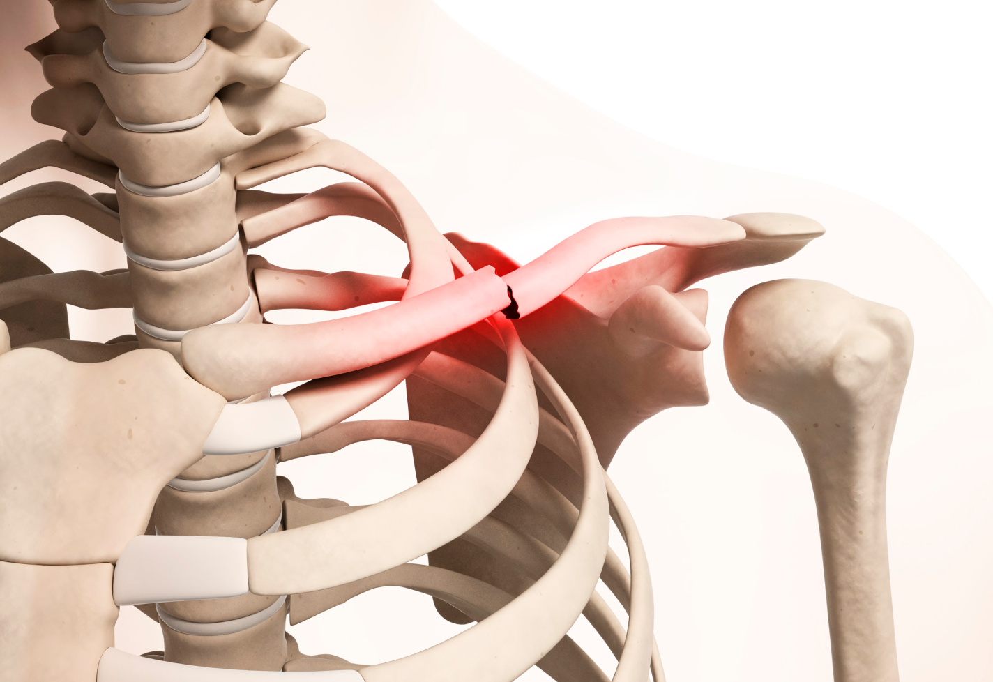 Close-up of a human skeleton showing a broken collarbone highlighted.