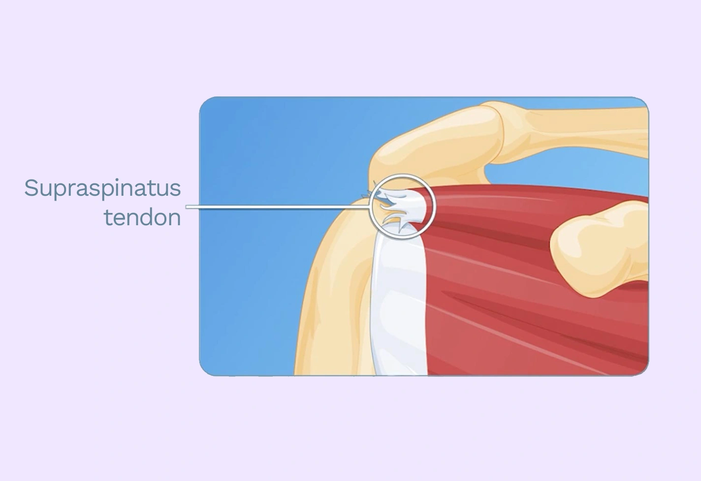 Diagram showing a torn supraspinatus tendon.