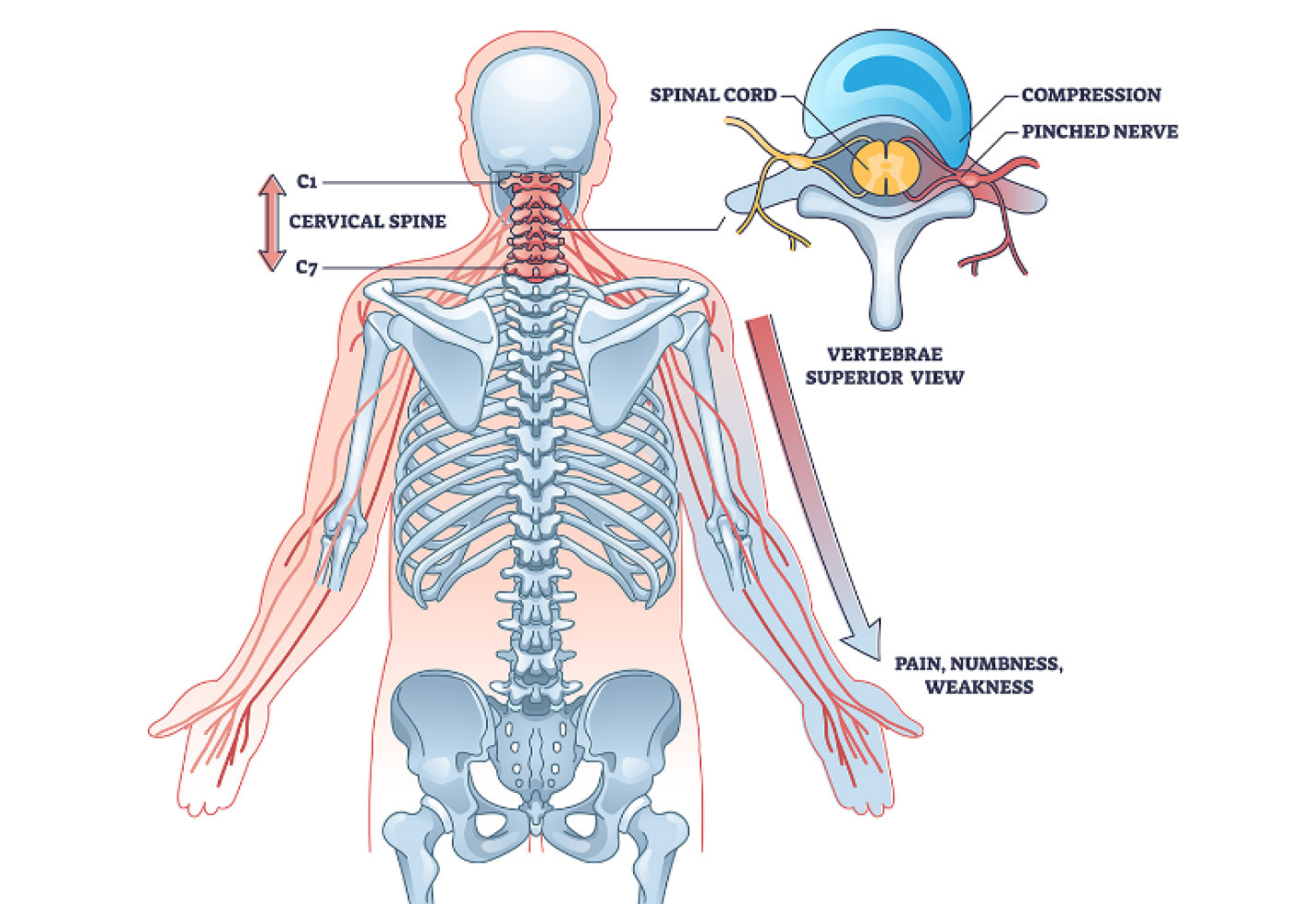 Diagram of the cervical spine showing C1 to C7 vertebrae, spinal cord, and nerve compression effects.