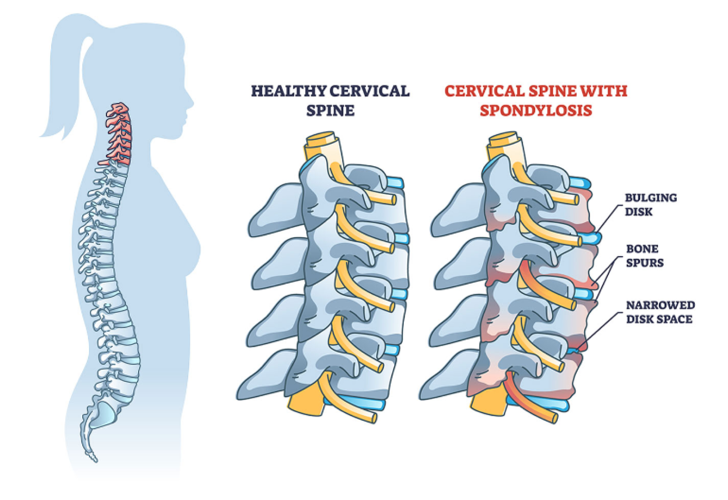 Illustration comparing a healthy cervical spine to one with spondylosis, labeled with bulging disk, bone spurs, and narrowed disk space.