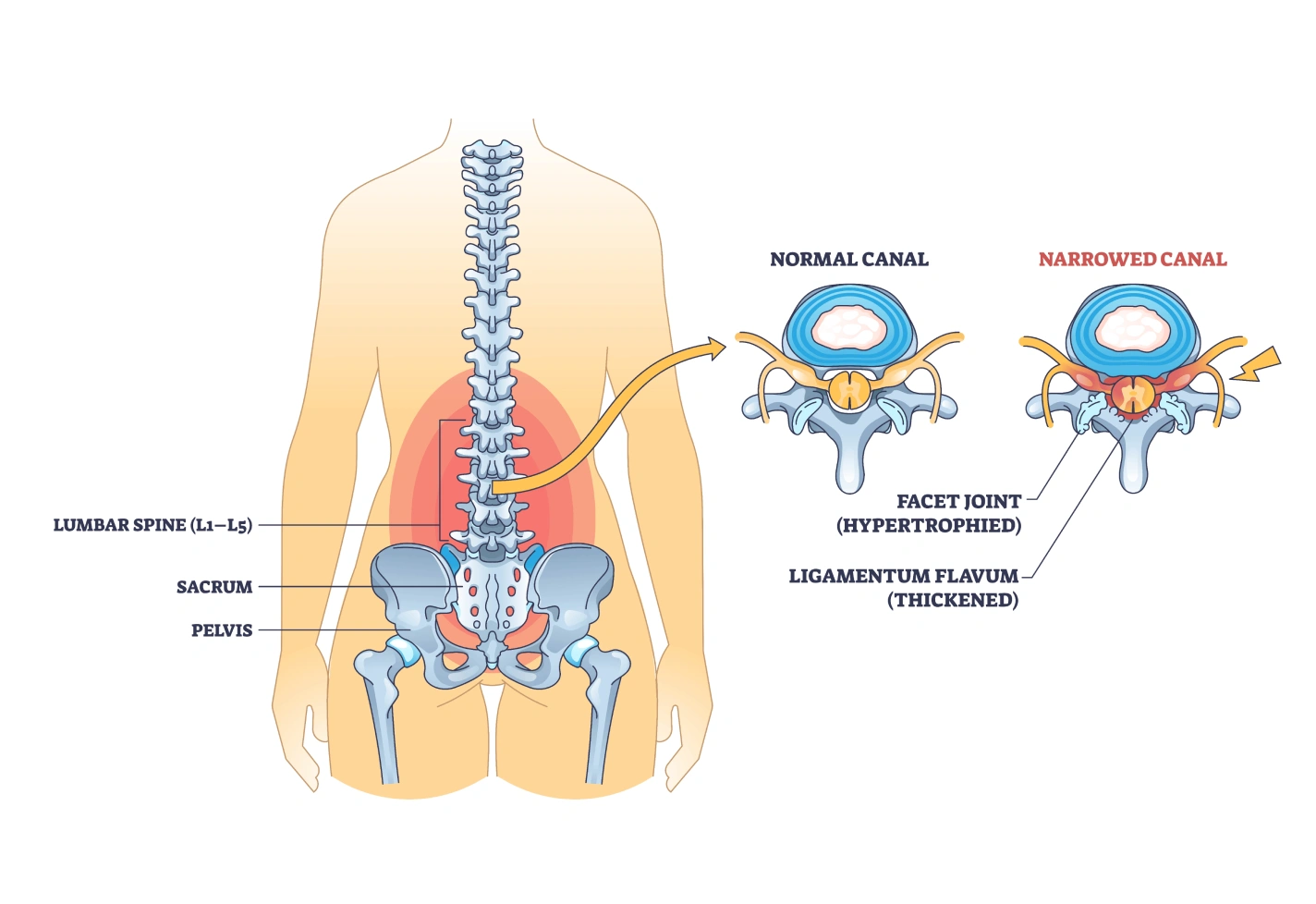 Diagram showing the lumbar spine, sacrum, and pelvis, with illustrations of normal and narrowed spinal canals.