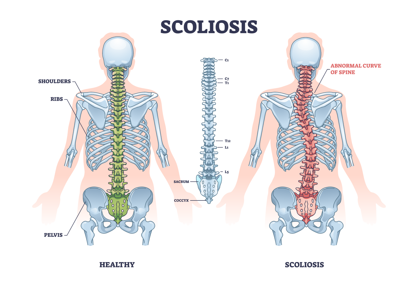 Illustration comparing a healthy spine with scoliosis. Green spine indicates healthy, red spine shows abnormal curve.