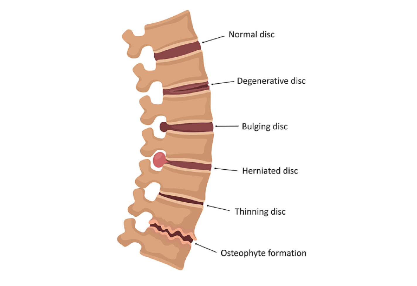 Side view of the spine showing normal, degenerative, bulging, herniated discs, thinning disc, and osteophyte formation.