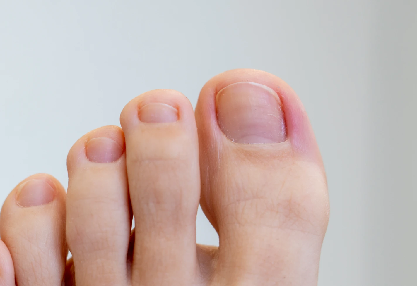 Close-up of a big toe with redness and swelling along the edge of the toenail.