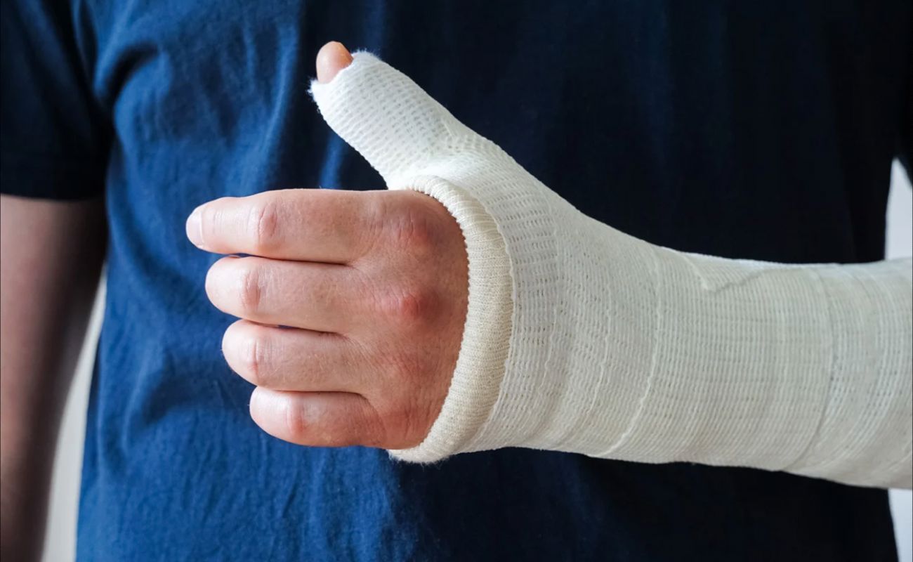 Patient with an arm cast for wrist or hand injury